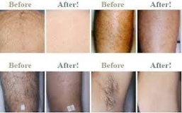 Laser Hair Removal Marietta Johns Creek Stockbridge Lawrenceville