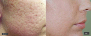 Laser Skin Resurfacing Marietta, Johns Creek, Stockbridge, Lawrenceville