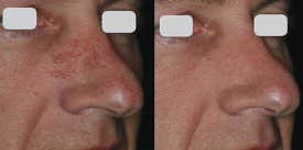 IPL Photo Facial Marietta, Johns Creek, Lawrenceville, Stockbridge