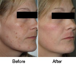 IPL Photo Facial Marietta, Johns Creek, Lawrenceville, Stockbridge