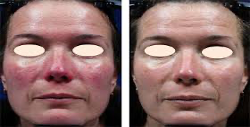 rosacea treatment johns creek, marietta, lawrenceville, stockbridge