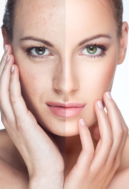 acne treatment