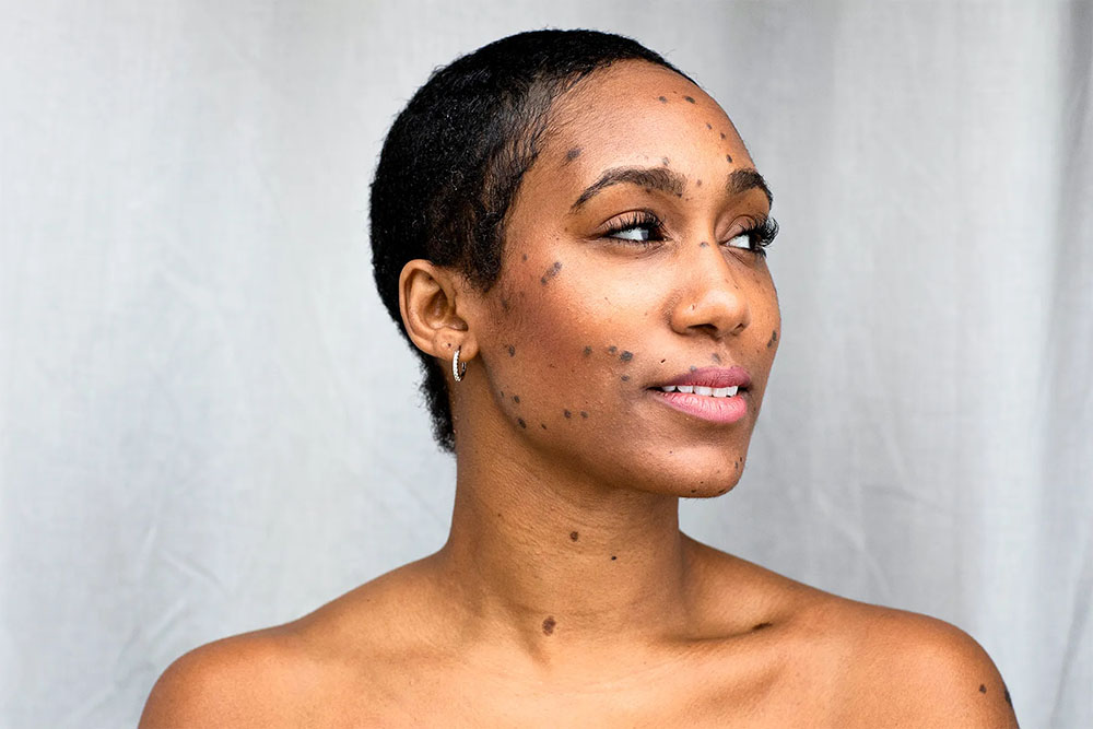 Dermatosis Papulosa Nigra Removal Options