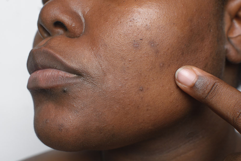 Dark Spots after Acne Treatment