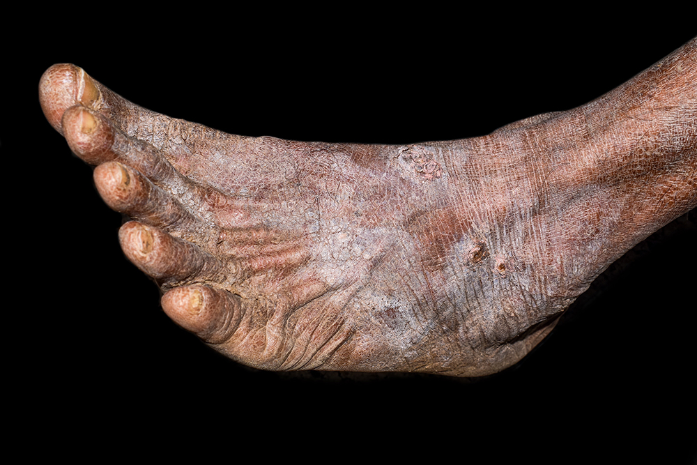 dry skin black patients decatur