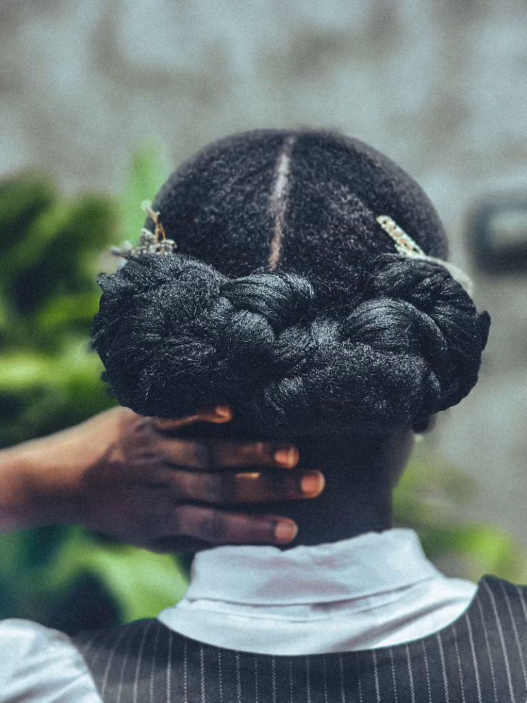 Adolescent Alopecia in Black Teens