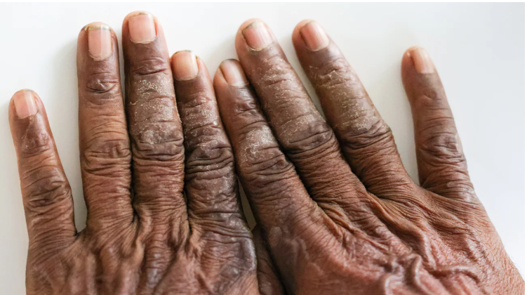 Chronic Hand Eczema